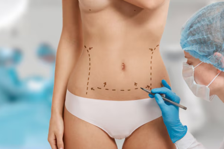 Abdominoplastia beneficios