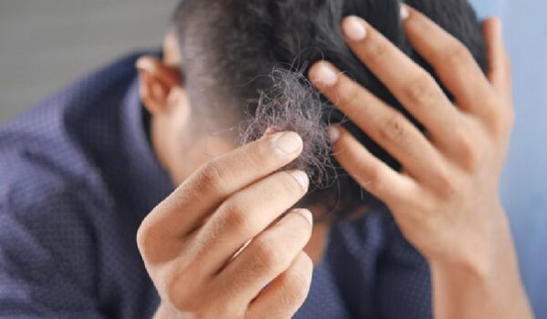 Minoxidil, entre los productos más eficaces para combatir la pérdida del cabello